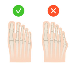 Taylor deformation. Valgus deformity of the little toe joint. Vector illustration.