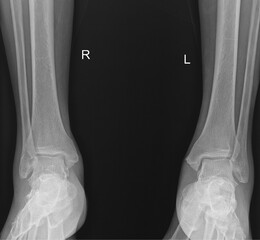 Film x-ray of human both ankle joints and ligaments Medical image concept.