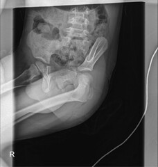 Pediatric Pelvis X-Ray for Clinical Assessment