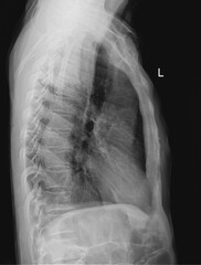 Chest Lateral Radiograph for Thoracic Imaging