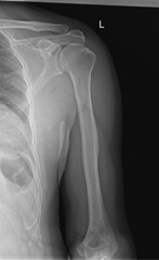 High-Resolution X-Ray of the Shoulder Joint: Glenohumeral Imaging