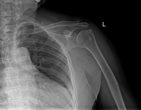 Detailed Radiographic Imaging of the Glenohumeral Joint - Shoulder X-Ray