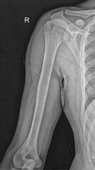 Right Shoulder Radiograph in Antero-Posterior View for Diagnosis
