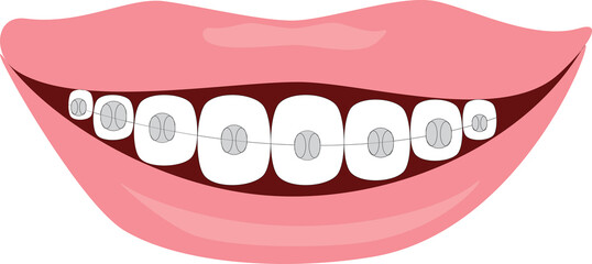 A vector art of mouth opened with a smile and wearing braces.
