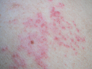 Shingles (Herpes Zoster, Shingles) is a type of skin disease. This is caused by the Varicella Zoster Virus,. Causes inflammation of the nerves burning pain and a rash along the nerves.