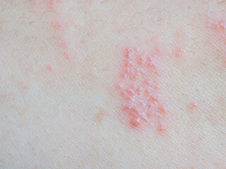 Shingles (Herpes Zoster, Shingles) is a type of skin disease. This is caused by the Varicella Zoster Virus,. Causes inflammation of the nerves burning pain and a rash along the nerves.