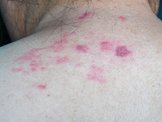 Shingles (Herpes Zoster, Shingles) is a type of skin disease. This is caused by the Varicella Zoster Virus,. Causes inflammation of the nerves burning pain and a rash along the nerves.