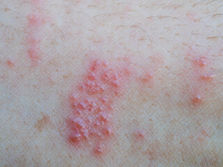 Shingles (Herpes Zoster, Shingles) is a type of skin disease. This is caused by the Varicella Zoster Virus,. Causes inflammation of the nerves burning pain and a rash along the nerves.