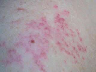 Shingles (Herpes Zoster, Shingles) is a type of skin disease. This is caused by the Varicella Zoster Virus,. Causes inflammation of the nerves burning pain and a rash along the nerves.