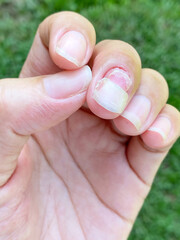 Middle finger's nail has been almost pulled out entirely. The cracked nail was caused by an allergy infection that affected the underneath proximal nail fold. 