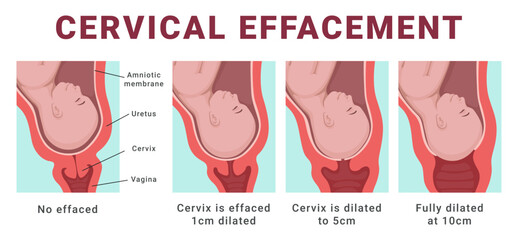 Cervical effacement human childbirth steps medical scheme poster vector flat illustration