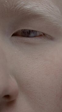 Close up portrait of the eye of an Asian albino guy. Genetic mutation of the pigment. Man with nystagmus, uncontrolled rhythmic movements of the eyeballs, Pathological nystagmus