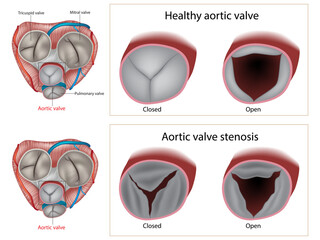 Aortic valve stenosis and Healthy aortic valve. Valvular heart disease. Anatomy heart 