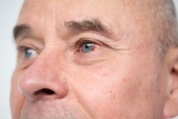 Bloodshot male eye in close-up shot, revealing raw detail burst vessel and underlying stress,...