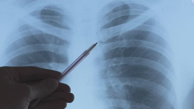 Close up broken bone. Doctor examining X-ray scan of  Dislocation of the acromial end of the clavicle.