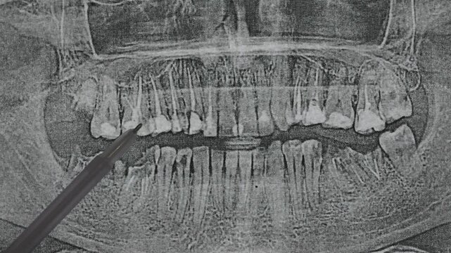 Doctor examining Panoramic dental X-Ray of teeth. Diseased teeth with dental fillings, crowns, sealants.