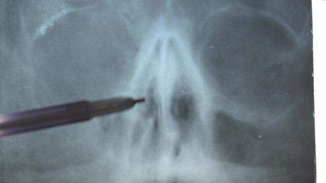 Doctor examining  x-ray face skull sinus. Human broken nose trauma.