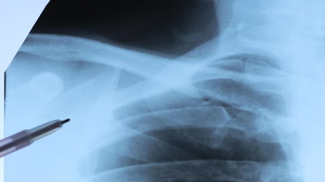 X-ray scan of  Dislocation of the acromial end of the clavicle.