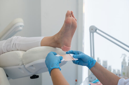 A podologist wearing gloves glues a special relief corn patch on the heel of the patient. Patient on medical pedicure procedure, visiting podiatrist. Peeling feet. Foot treatment in SPA salon.Podiatry