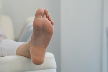 A podologist wearing gloves glues a special relief corn patch on the heel of the patient. Patient on medical pedicure procedure, visiting podiatrist. Peeling feet. Foot treatment in SPA salon.Podiatry