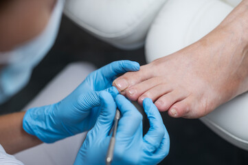 The podologist cleans the patient's nail using a curette tool. Patient on medical pedicure...