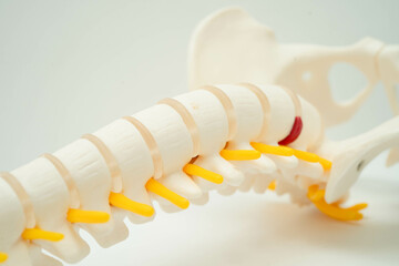 Spinal nerve and bone, Lumbar spine displaced herniated disc fragment, Model for treatment medical in the orthopedic department.