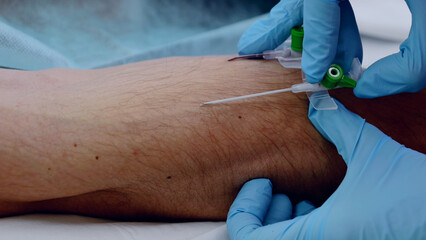 Surgeon wearing blue gloves demonstrates precision and focus while inserting an iv catheter into a...