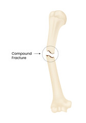 Causes of the Compound Fracture