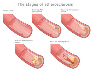 Stages of atherosclerosis medical diagram. Vector Illustration of several stages of atherosclerosis development.