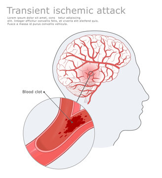 Transient ischemic attack medical illustration. Human brain and Transient ischemic attack. Vector medical illustration.