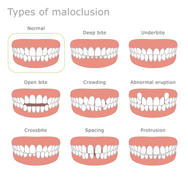 Types of malocclusion dental illustration. The illustration shows different types of human malocclusion.