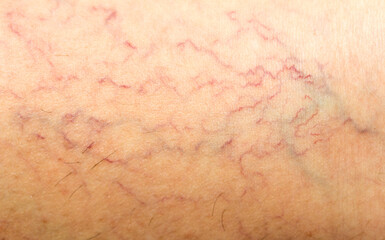 varicose veins on the skin