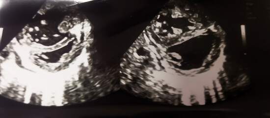 Severe Pulmonary stenosis with pulmonary  hypertension of echocardiography in a patient. RA and RV diluted.