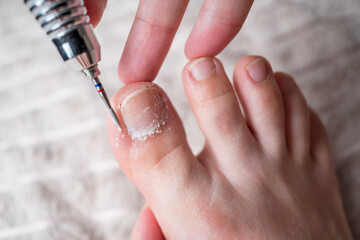 Hardware pedicure for yourself, ingrown toenail, chiropody and podology concept, foot care