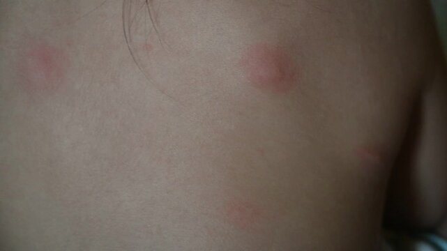 Mosquito bite marks on the skin of a toodler child's back.
