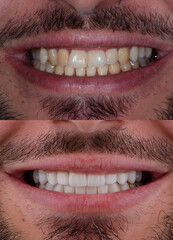 Male full smile makeover with ceramic ultra-thin natural looking aesthetic veneers. Before and after