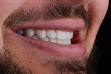 Male full smile makeover with ceramic ultra-thin natural looking aesthetic veneers. Dental treatment
