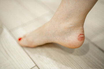 Close-up callus on a woman's ankle caused by wearing the wrong shoes