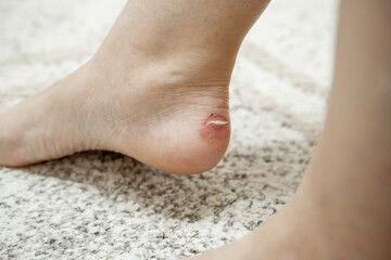 Close-up callus on a woman's ankle caused by wearing the wrong shoes