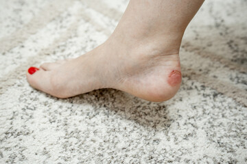 Close-up callus on a woman's ankle caused by wearing the wrong shoes