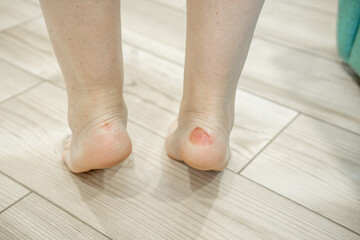 Close-up callus on a woman's ankle caused by wearing the wrong shoes