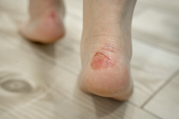 Callus on the foot.  A wound on the leg from a callus.