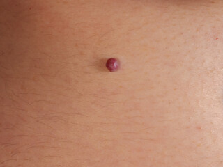 Mole &ndash; a soft, pigmented mole protruding above the skin surface, close-up mcro photo with lots of detail