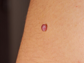 Mole – a soft, pigmented mole protruding above the skin surface, close-up mcro photo with lots of...