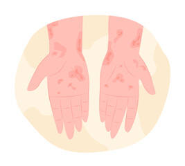 Eczema or Skin Rashes on Human Hands for Dermatology Concept Illustration
