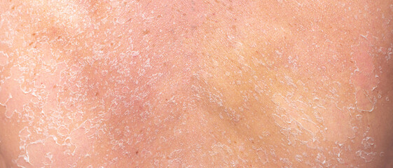 Sunburn, close-up of human skin. Flaky skin from allergies, peeling or eczema. Dry skin in need of treatment and hydration.