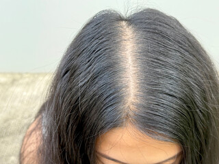Women with hair loss dryness and frizziness