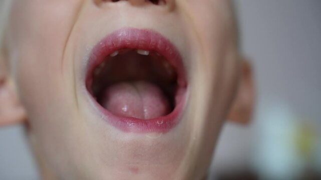 Child opens his mouth to show loose baby tooth and an erupting front permanent tooth next to it, close-up. Baby teeth are replaced by permanent teeth. Pediatric dentistry, changing teeth. 