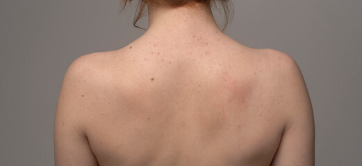 Skin texture background. Acne pimple on back. Treatment for skin. Problem skincare. Pimples and...