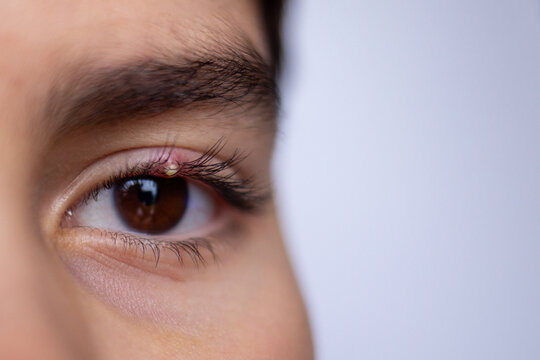 Macro shot close-up of human eye with small stye on upper eyelid, highlighting inflammation and irritation. Health and medical concept for infection symptoms and eye care